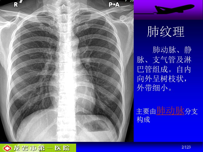 肺动脉栓塞影时像诊断-1ppt课件.ppt_第2页