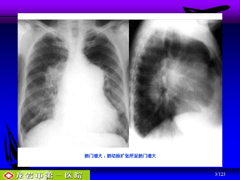 肺动脉栓塞影时像诊断-1ppt课件.ppt_第3页
