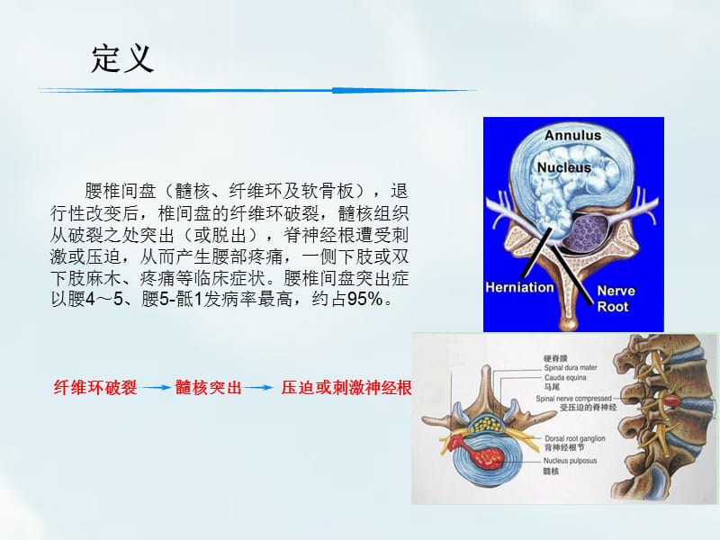 腰椎间盘突出的点诊治ppt课件.ppt_第3页