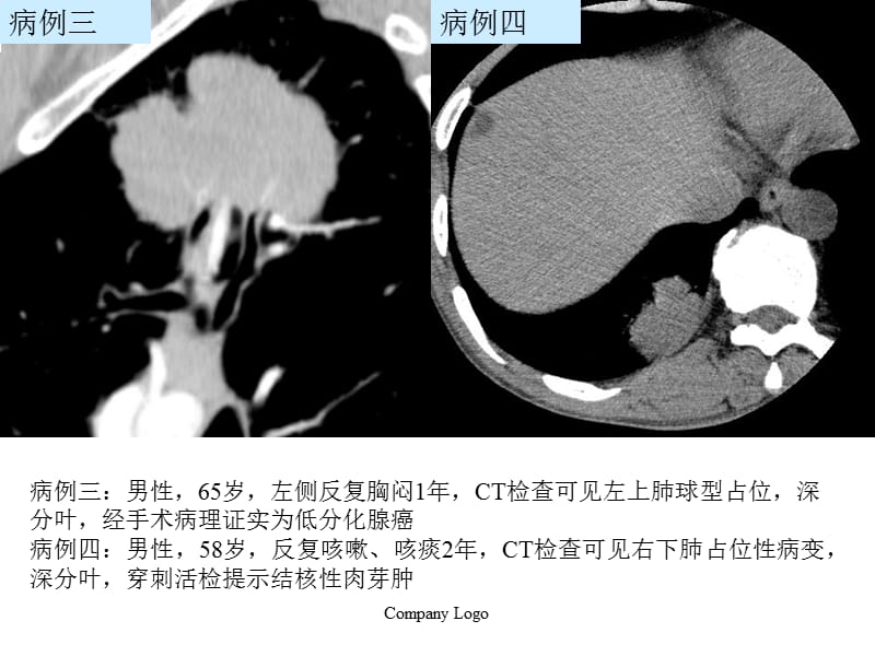 肺结核--球形结核的影像诊断与鉴关别诊断ppt课件.ppt_第3页