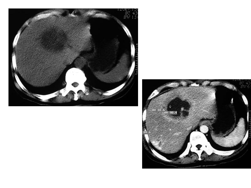肝脏疾等病影像诊断2ppt课件.ppt_第3页