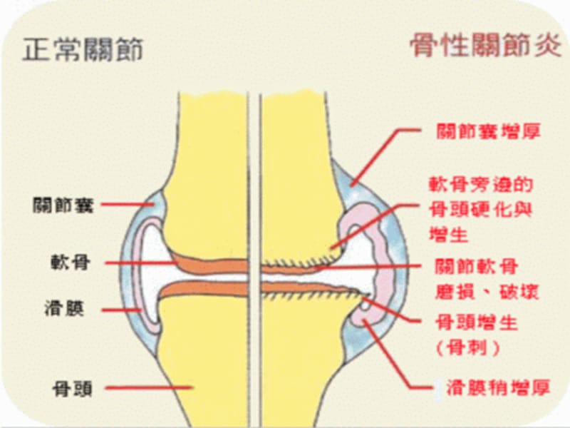 膝关节骨关节炎说的ppt课件.ppt_第3页