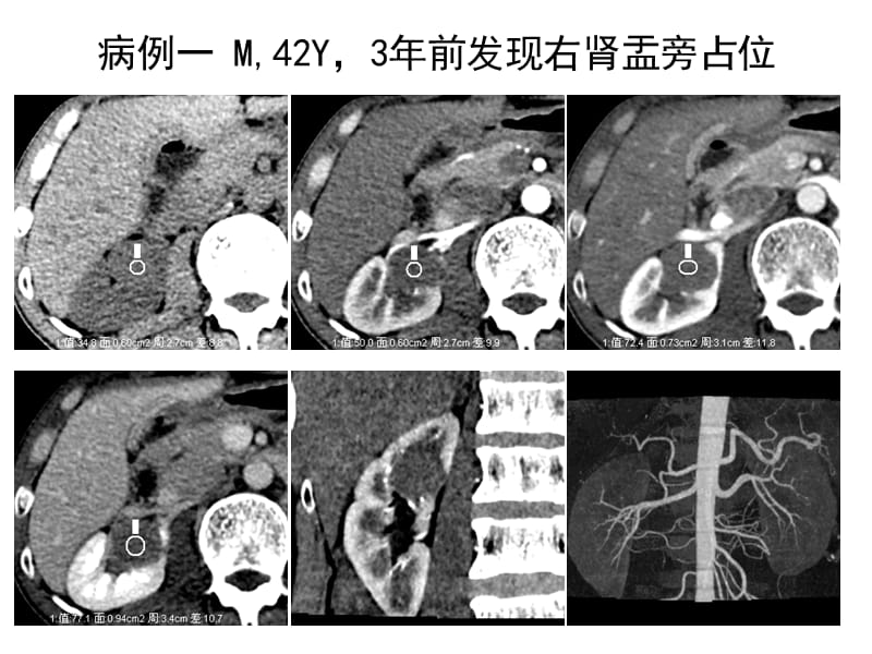 肾脏占位病你例随访ppt课件.ppt_第3页