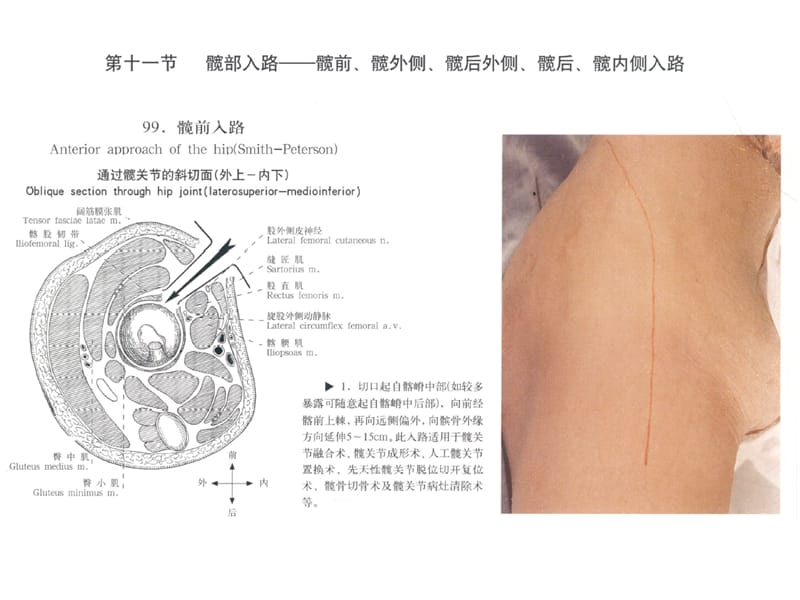 髋关节手术入呢路ppt课件.ppt_第2页