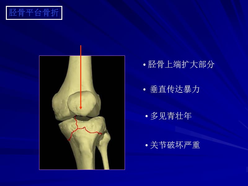 胫骨平台骨折.ppt_第2页