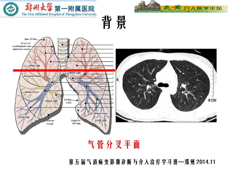 重度气道狭窄：x线下活检技术的ppt课件.ppt_第3页