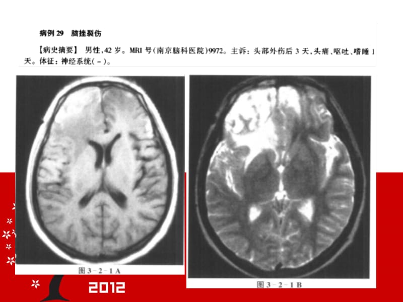 颅脑损伤的等mri诊断1ppt课件.ppt_第2页