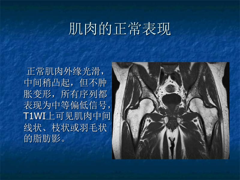 骨骼肌损伤条mri表现ppt课件.ppt_第3页