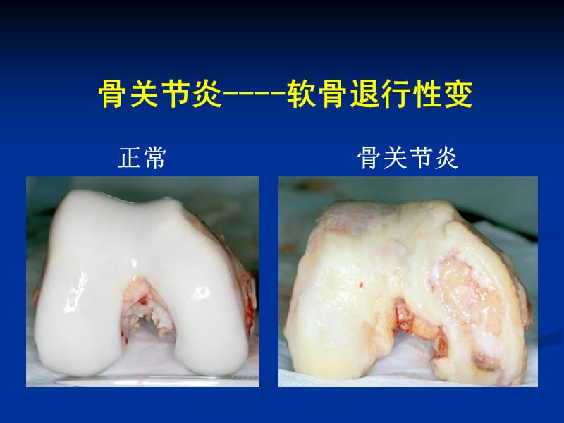 骨关节炎的药物到治疗解放军总医院陈继营教授ppt课件.ppt_第3页