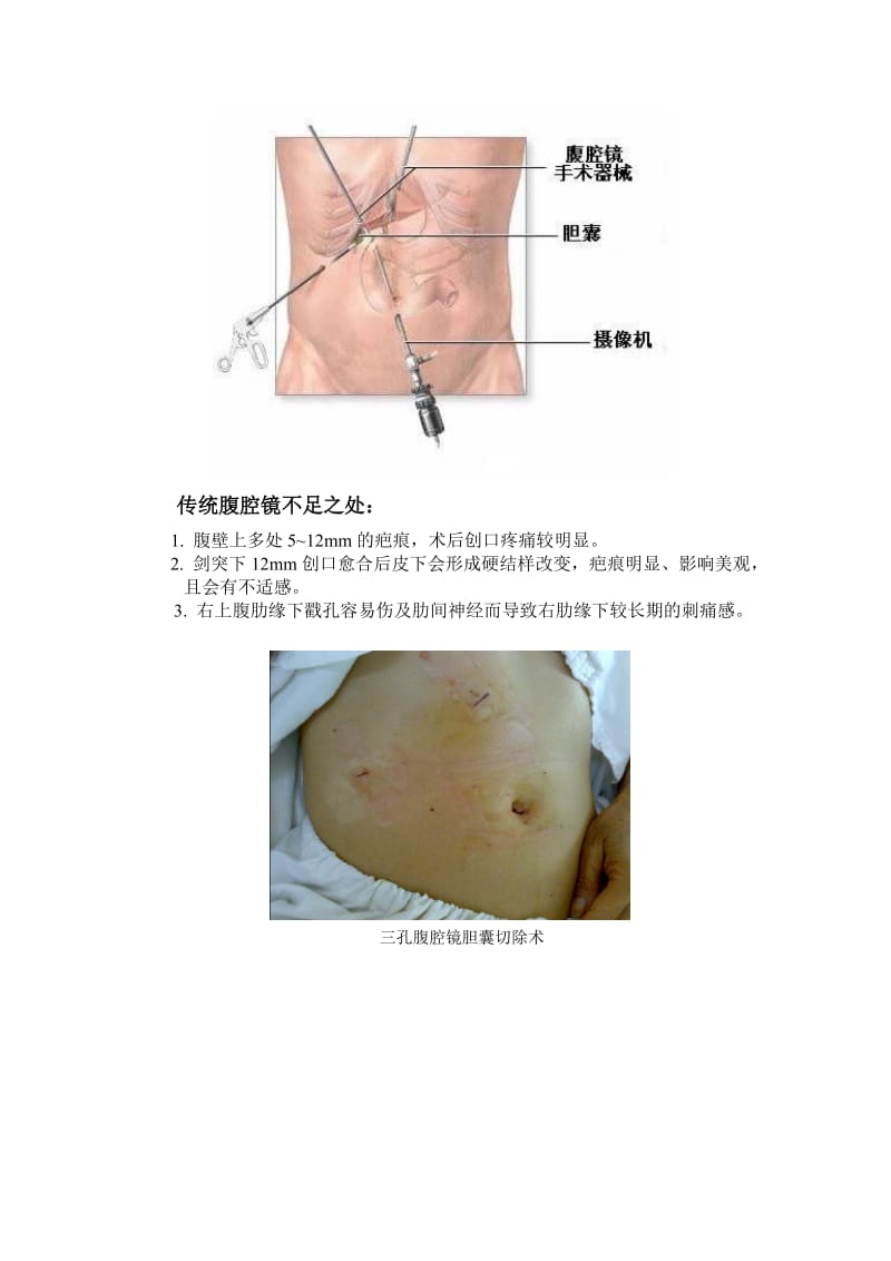 双孔腹腔镜-微博版.doc_第2页