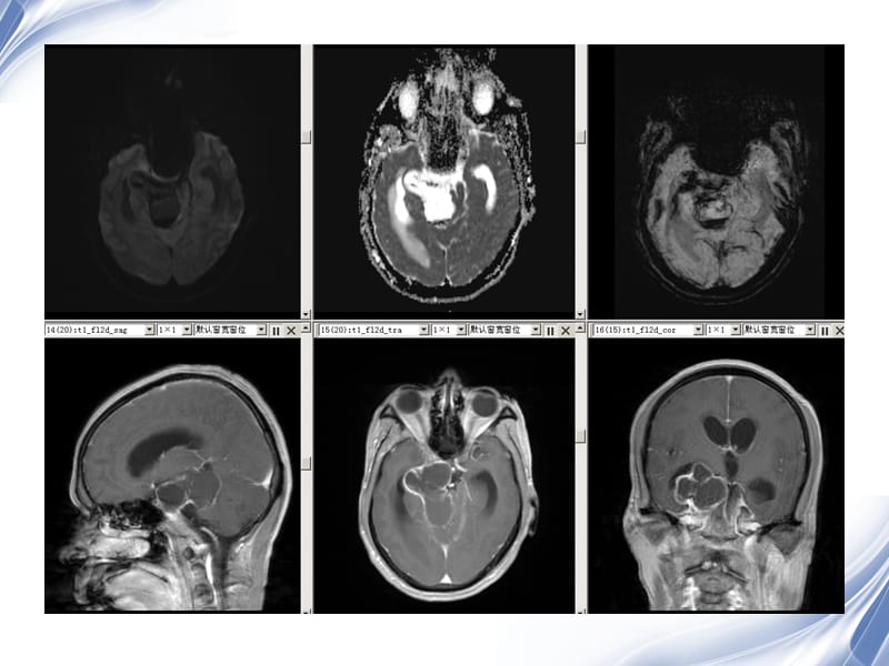 医学影像-垂体瘤的MR诊断与鉴别.ppt_第3页