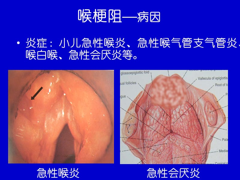 喉梗阻教学.ppt_第3页