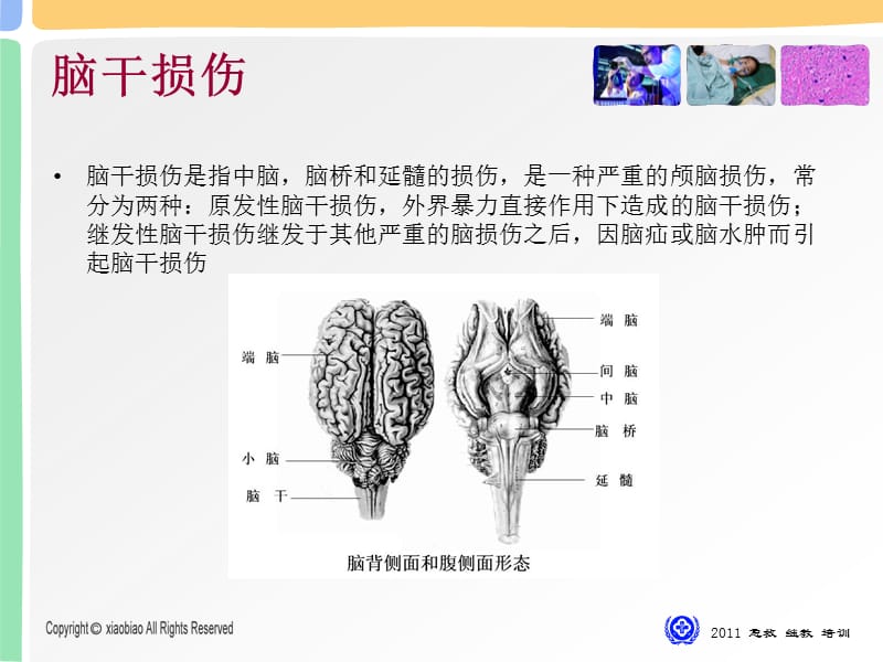 脑干损伤初探.ppt_第2页