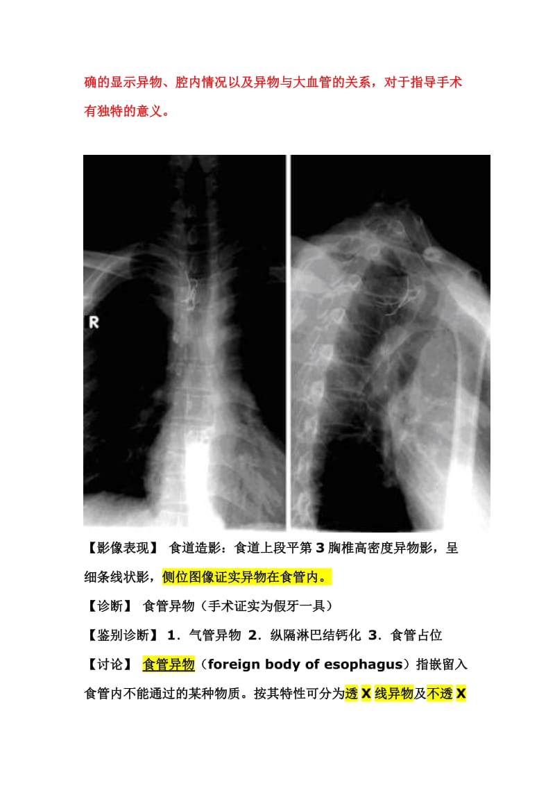 食管异物与气管异物鉴别诊断.doc_第2页