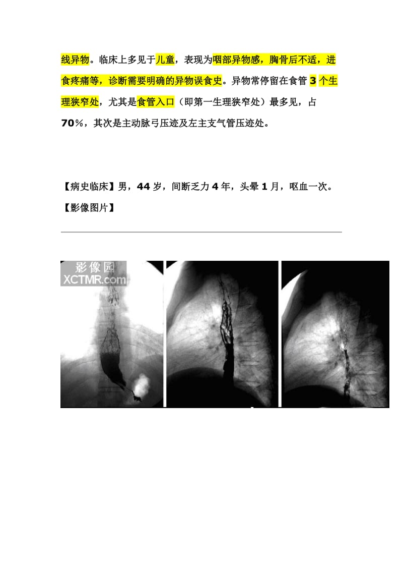 食管异物与气管异物鉴别诊断.doc_第3页