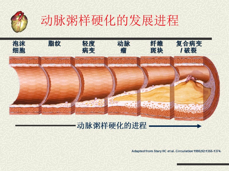 急性心肌梗死+吴洁.ppt_第2页