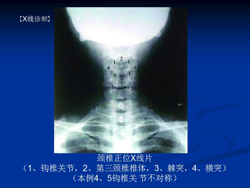 整脊影像学诊断.ppt_第2页