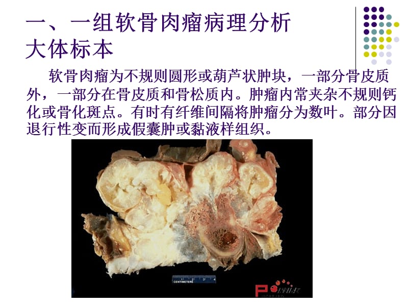 软骨肉瘤的病理及影像学表现.ppt_第1页