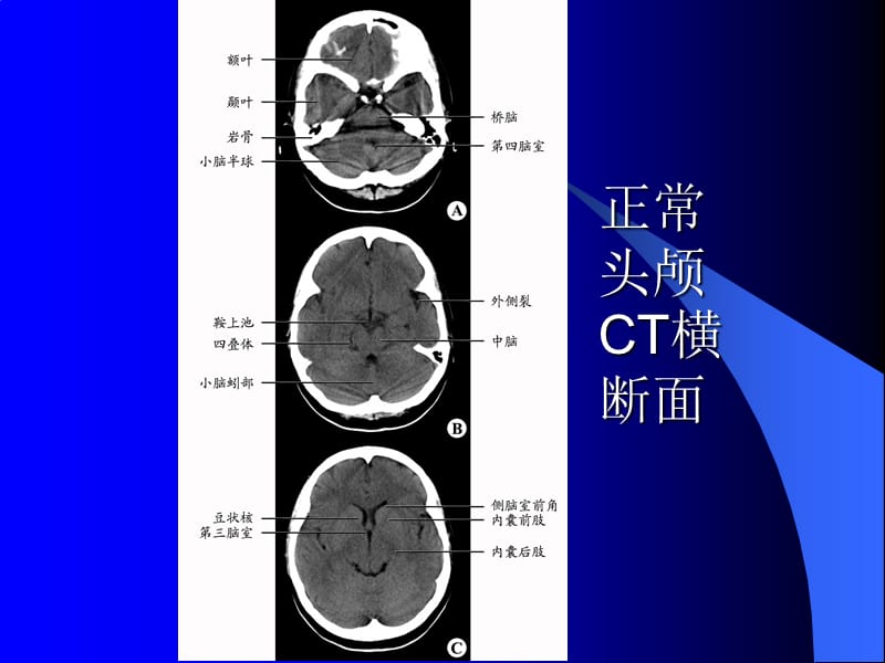 医学影像诊断学—头颈部病例.ppt_第2页