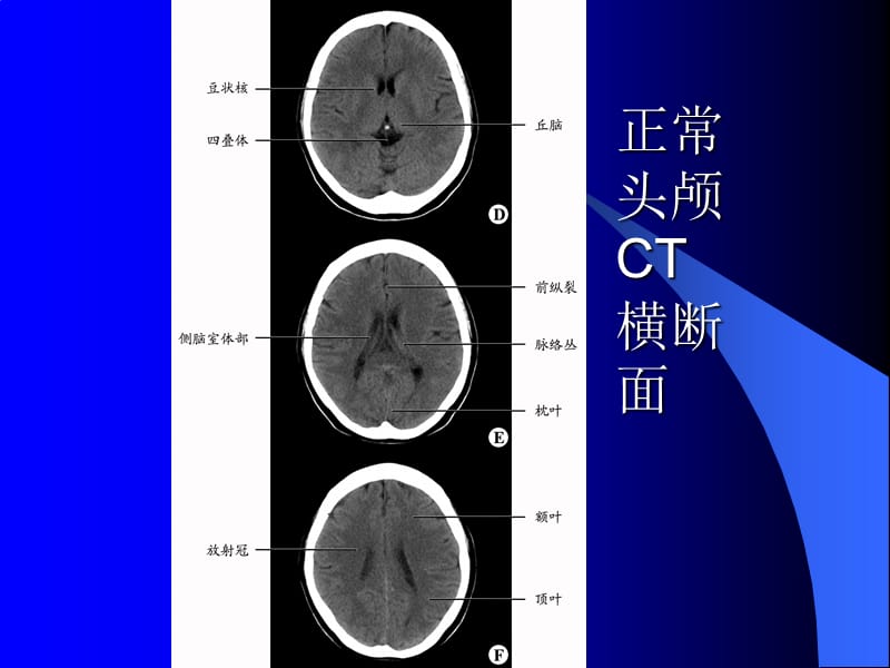 医学影像诊断学—头颈部病例.ppt_第3页