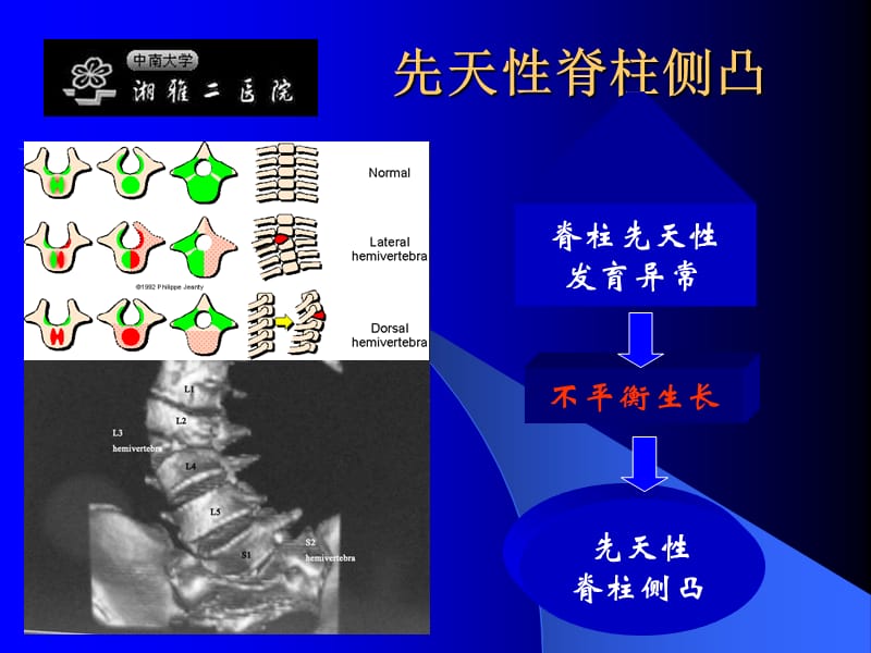 先天性脊柱侧凸的早期手术治疗.ppt_第2页