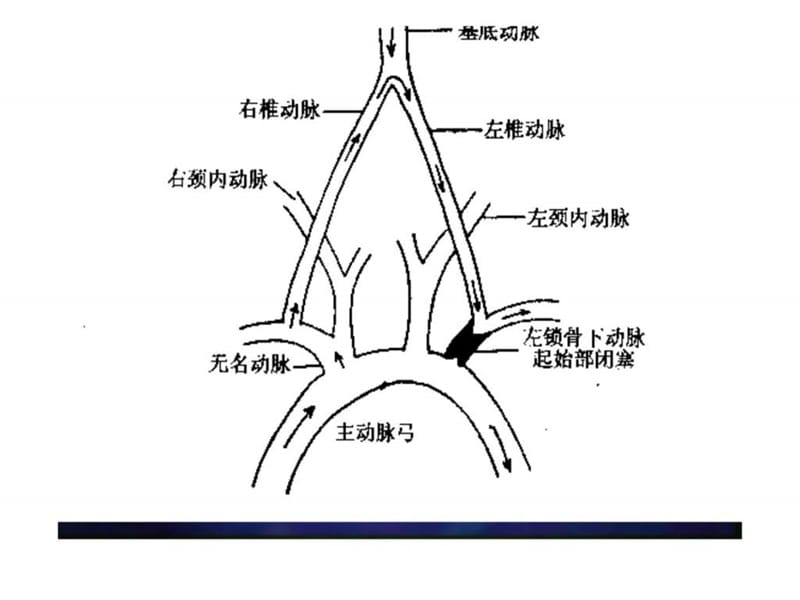 锁骨下动脉盗血综合征.ppt.ppt_第3页