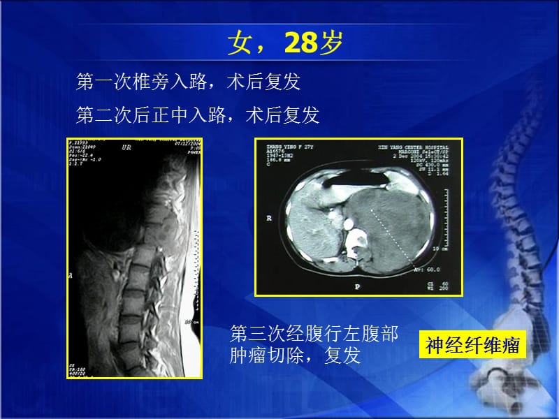 胸椎哑铃型肿瘤手术策略.ppt_第2页