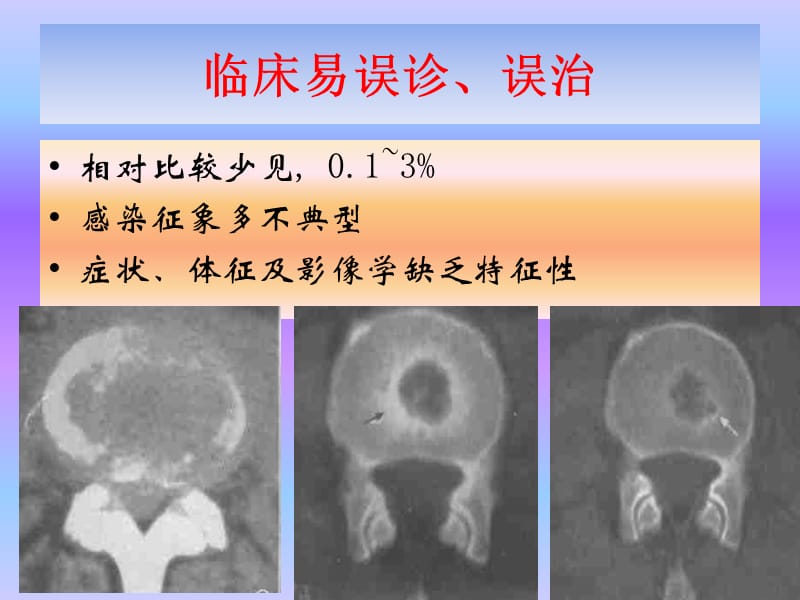 腰椎间隙感染的诊断和处理.ppt_第2页