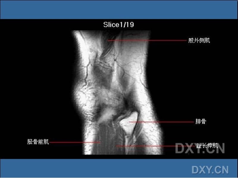 膝关节MRI.ppt_第1页