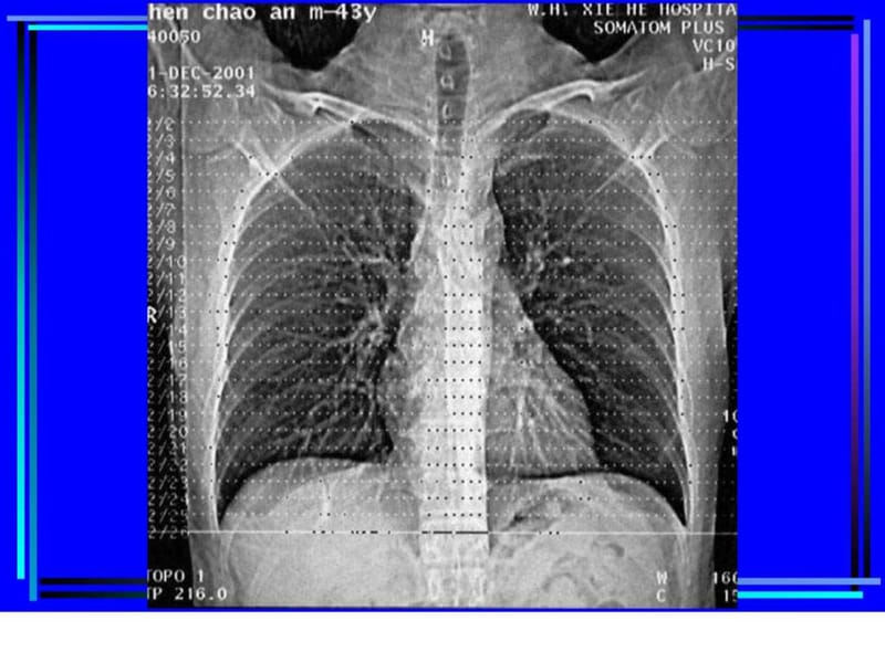 胸部CT诊断(大量实例CT片)_1529000741.ppt.ppt_第3页