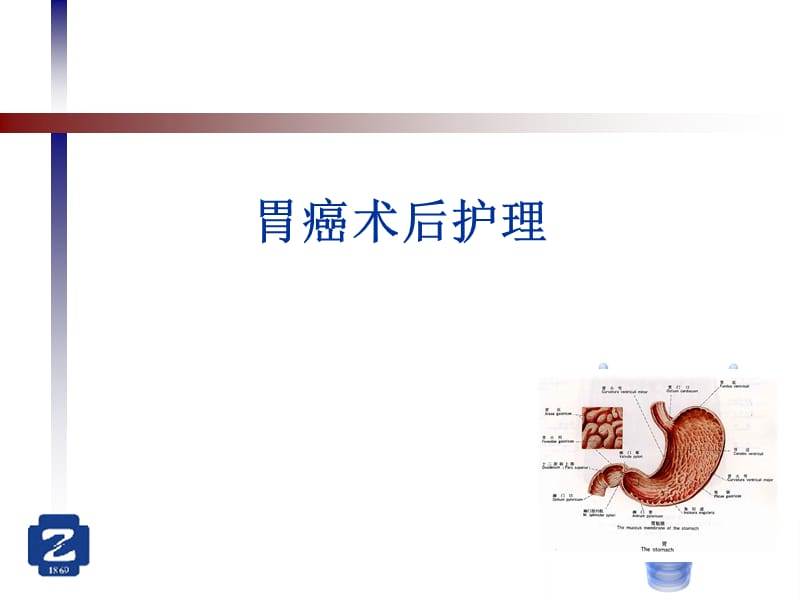 胃癌术后.ppt_第1页