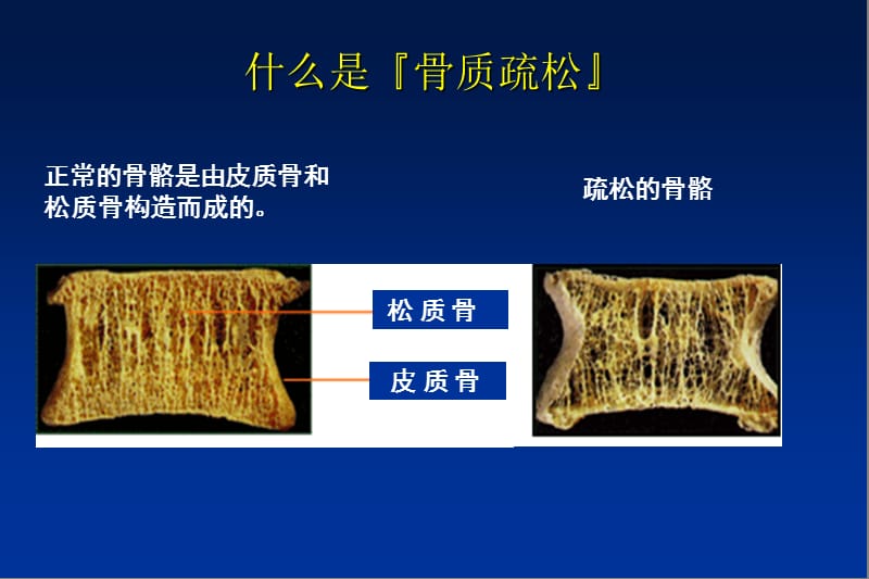 老年骨质疏松ppt课件.ppt_第3页