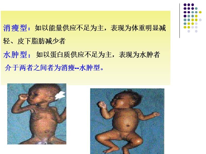 蛋白质—能量营养不良-1013 ppt课件.ppt_第3页