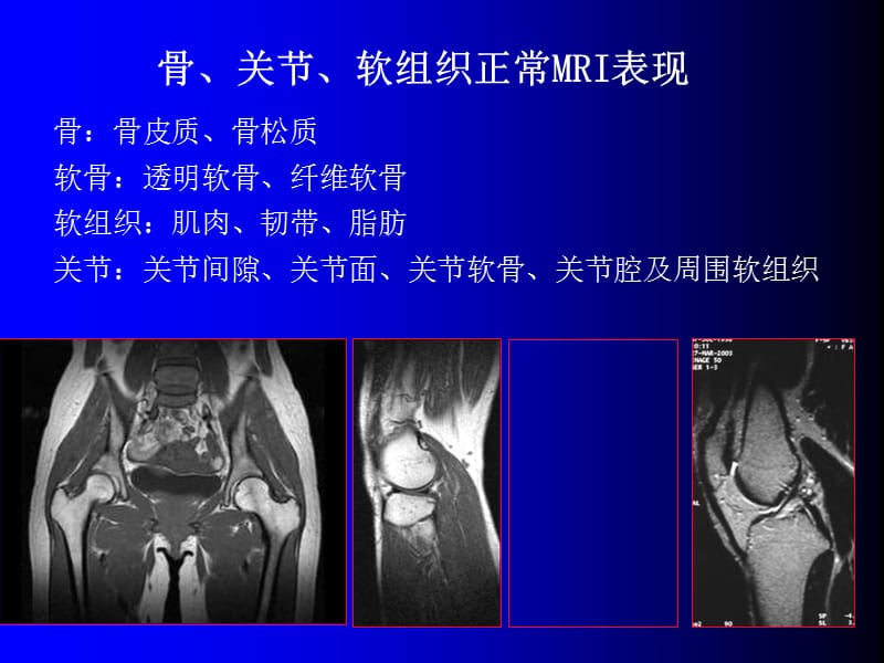 磁共振成像诊断 -骨、关节及软组织疾病.ppt_第3页