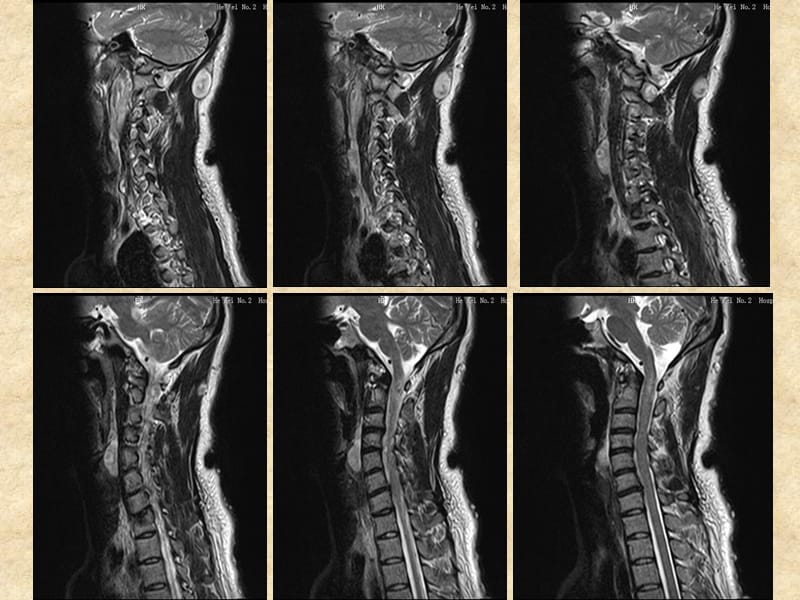 神经纤维瘤病的MR表现一例.ppt_第3页