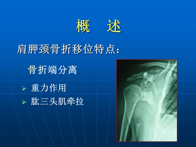 不稳定肩胛颈骨折的手术治疗.ppt_第3页