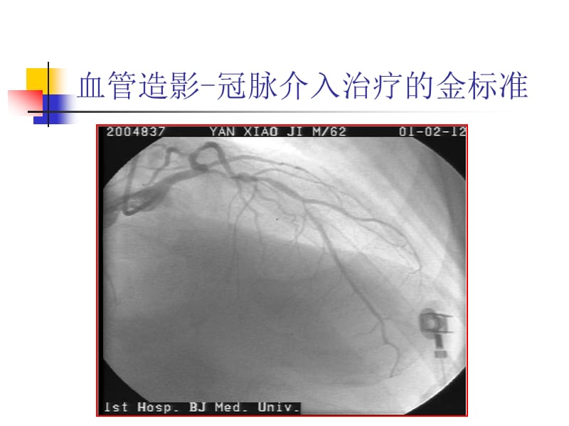 ivus基础知识 ppt课件.ppt_第2页