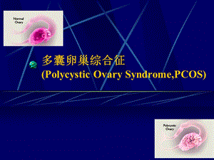 多囊卵巢.ppt