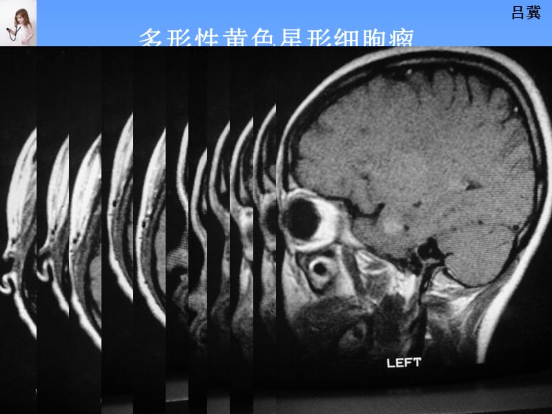 医影在线CNS疾病MRI诊断6.ppt_第3页