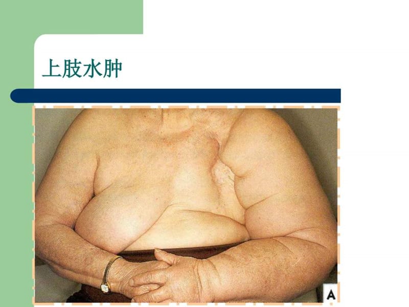 乳腺前哨淋巴结活检技术-乳腺外科的又一个里程碑_图文.ppt.ppt_第3页