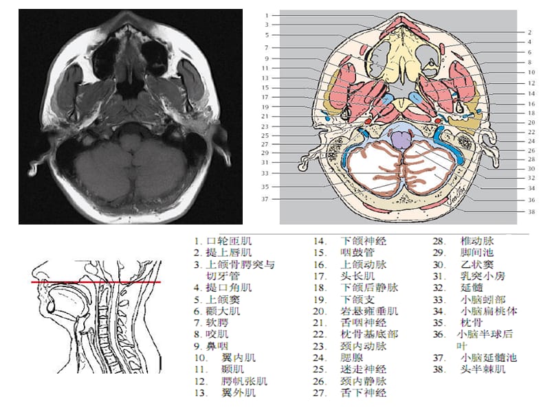 头颈CT-MRI解剖图解系列5.ppt_第3页