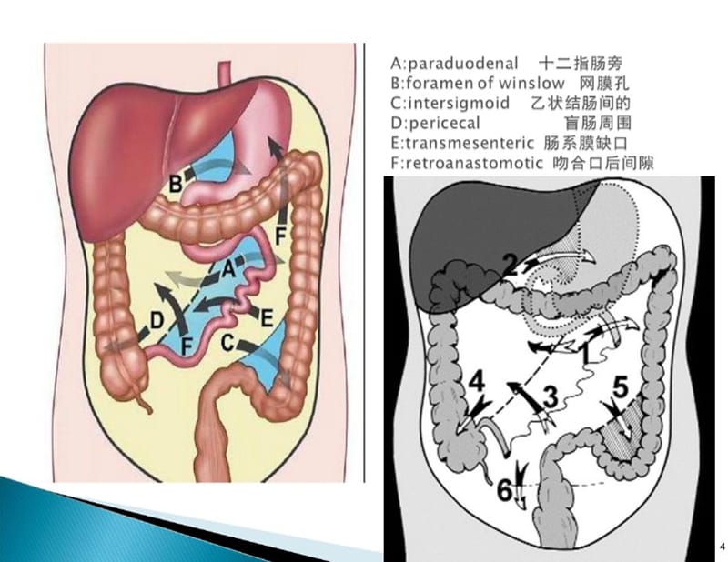 腹内疝影像诊断.ppt_第3页