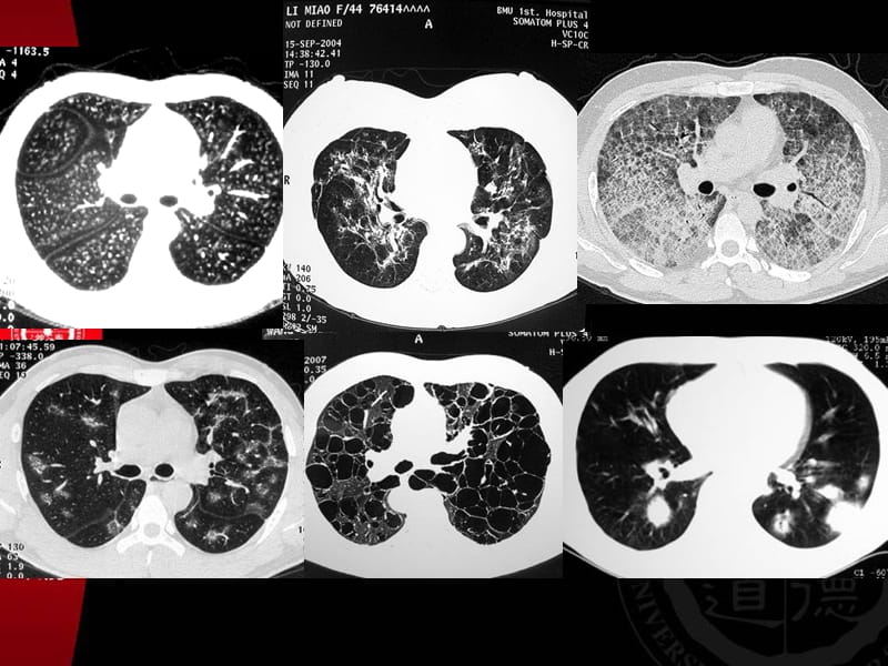 肺弥漫性疾病－多发结节样病变HRCT分析.ppt_第3页