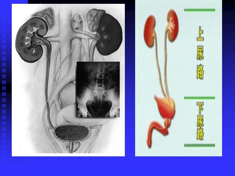 泌尿系结石.ppt_第3页