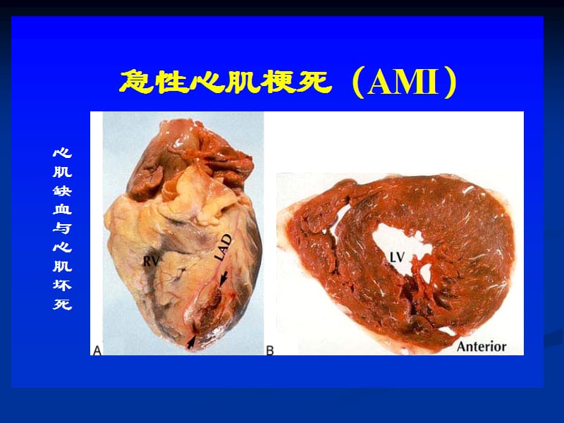 急性心梗的诊治(中西).ppt_第2页