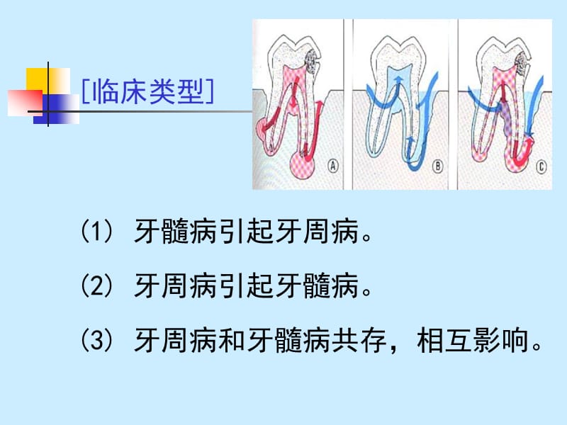 牙周炎治疗.ppt_第3页