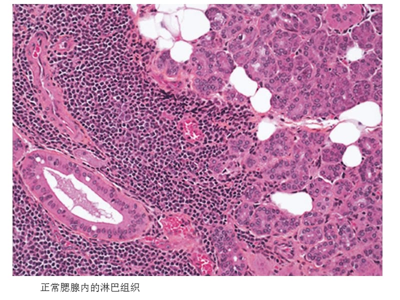 涎腺淋巴组织增生与淋巴瘤.ppt_第3页