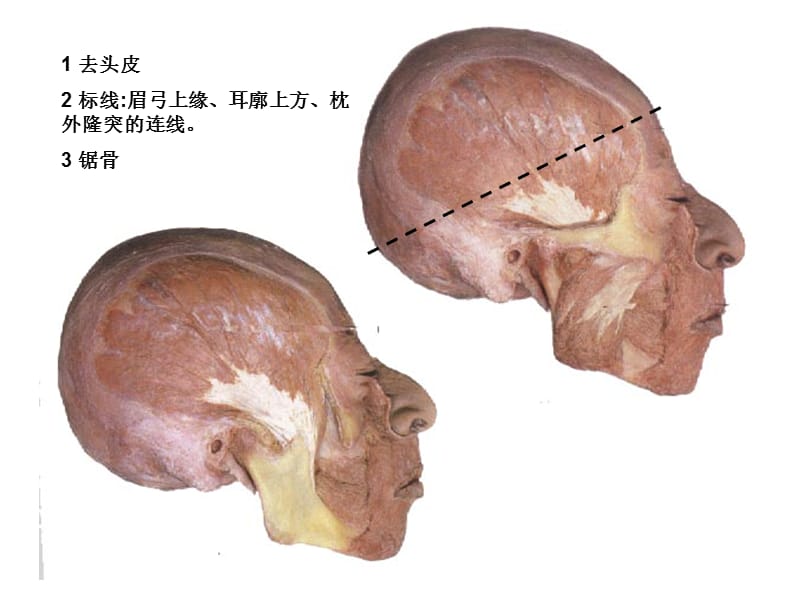 湘雅颅脑应用解剖2.ppt_第2页