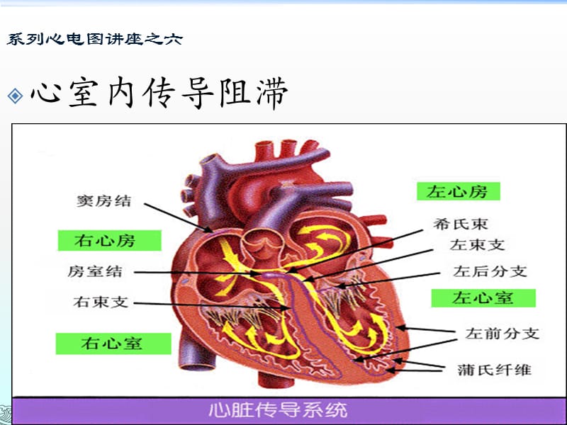 8心室内传导阻滞.ppt_第1页