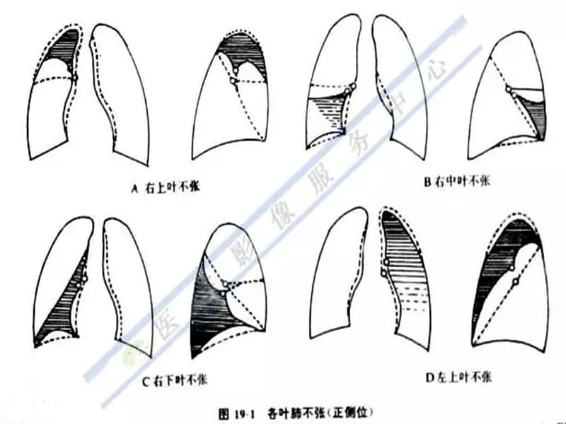 不同部位肺不张的影像特点.ppt_第3页